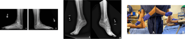 Dr. Jaffe removing the Maxframe Autostrut device and Hitaxi’s post-removal x-rays.