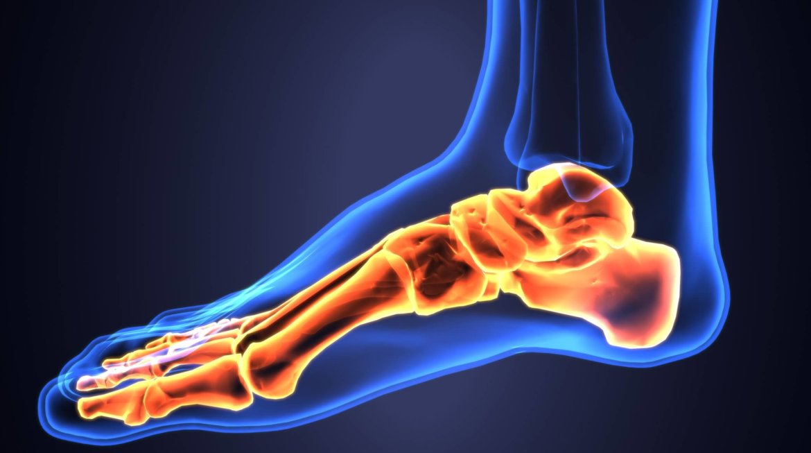 What Happens If Plantar Fasciitis Is Left Untreated?