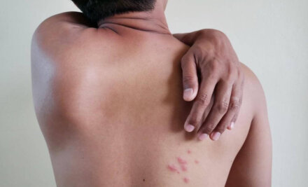 How To Manage Your Shingles Pain